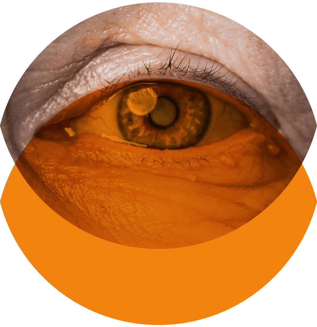 Oculux cataract